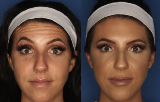 Botox Merseyside