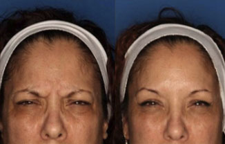 San Diego Botox