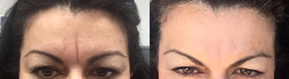 BOTOX Before & After Gallery - Patient 30336034 - Image 1