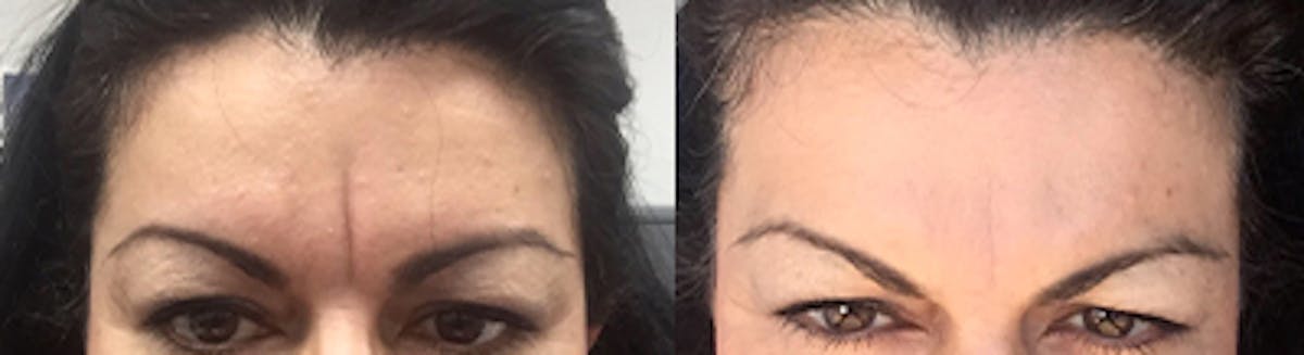 BOTOX Before & After Gallery - Patient 30336034 - Image 1