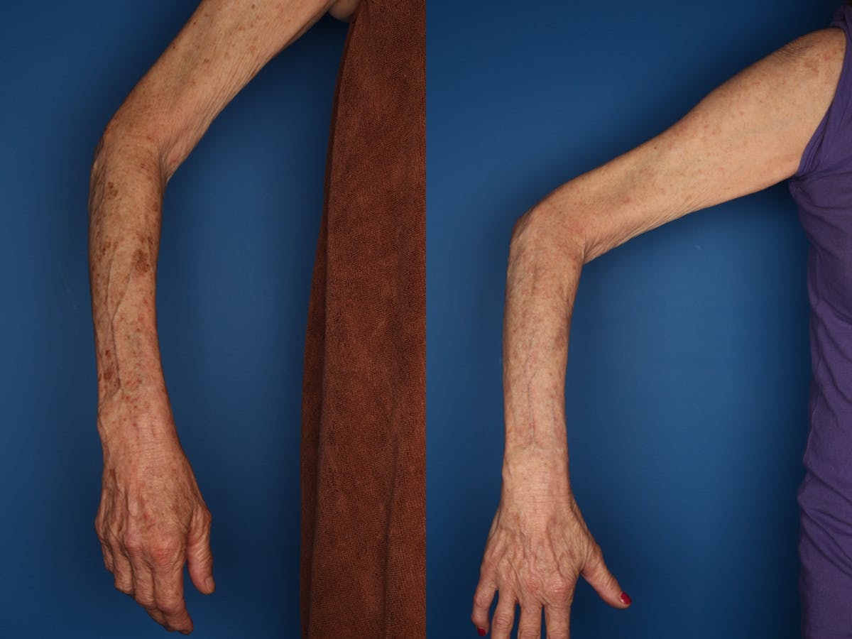 LaserFirm Gallery Before & After Gallery - Patient 30576201 - Image 1