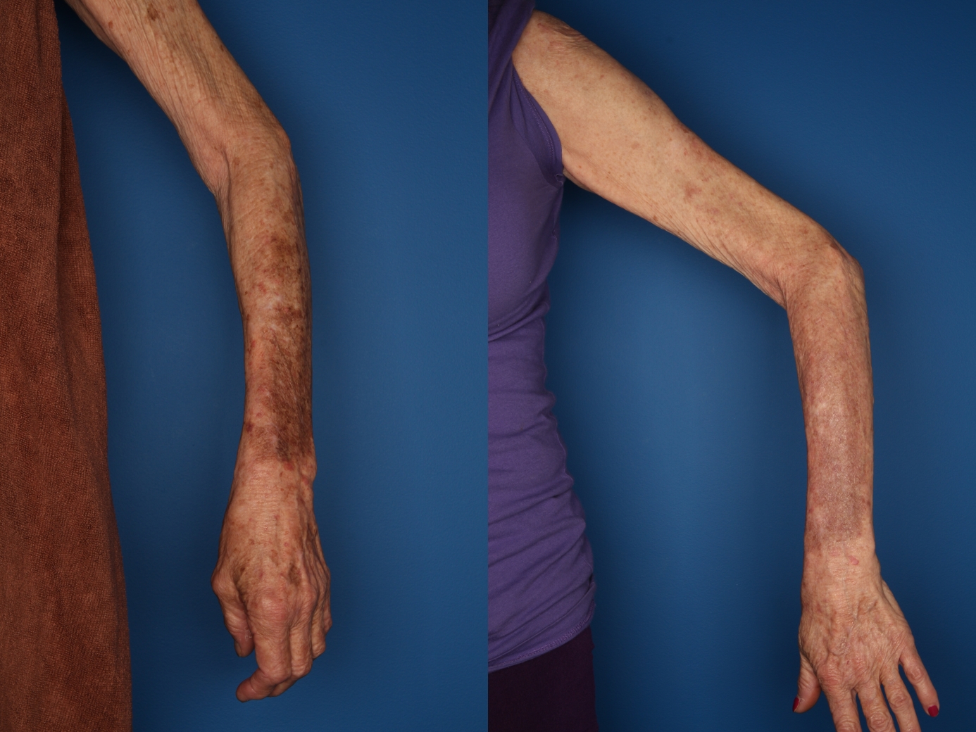 LaserFirm Before & After Gallery - Patient 30576201 - Image 2