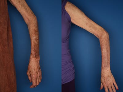 LaserFirm Gallery Before & After Gallery - Patient 30576201 - Image 2