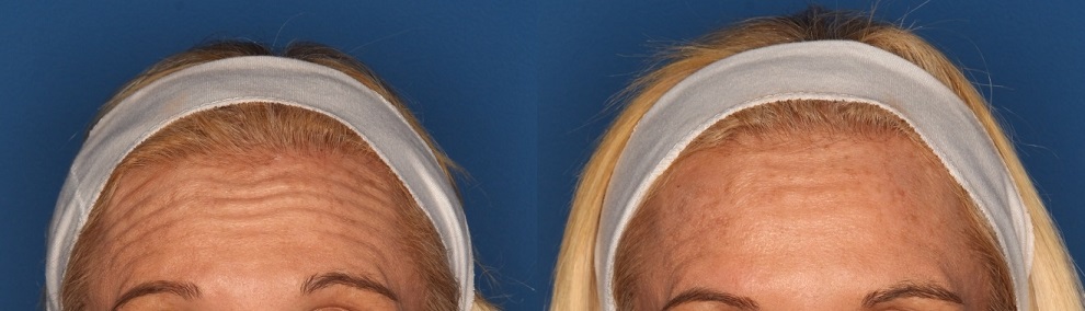 BOTOX Before & After Gallery - Patient 36601572 - Image 1