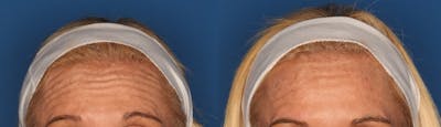 Botox/ Dysport/ Xeomin Before & After Gallery - Patient 36601572 - Image 1