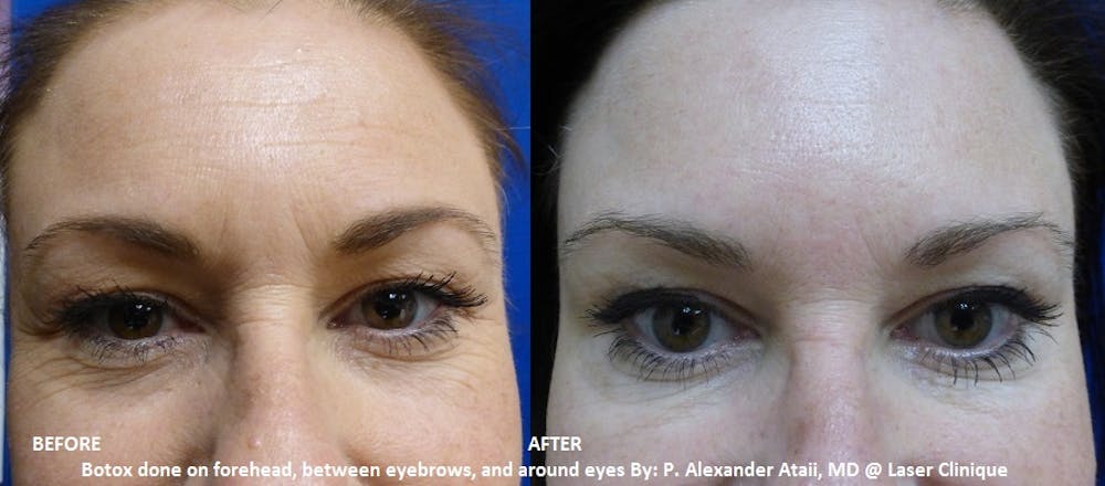 BOTOX Before & After Gallery - Patient 36601574 - Image 1