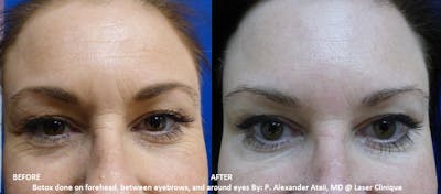 Botox/ Dysport/ Xeomin Before & After Gallery - Patient 36601574 - Image 1