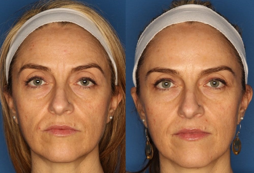 BOTOX Before & After Gallery - Patient 24560702 - Image 3