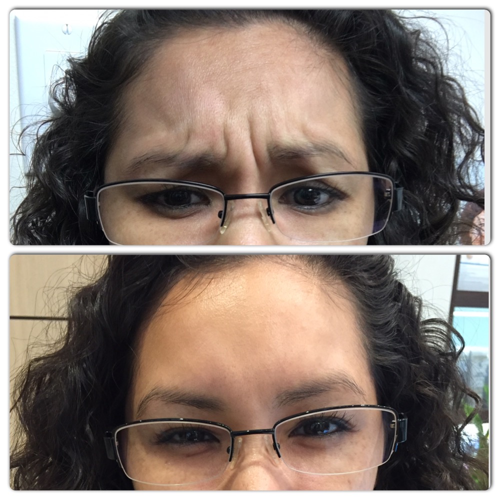 BOTOX Before & After Gallery - Patient 36601618 - Image 1