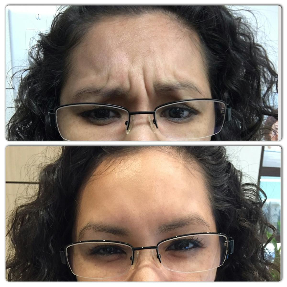 Botox/ Dysport/ Xeomin Gallery Before & After Gallery - Patient 36601618 - Image 1