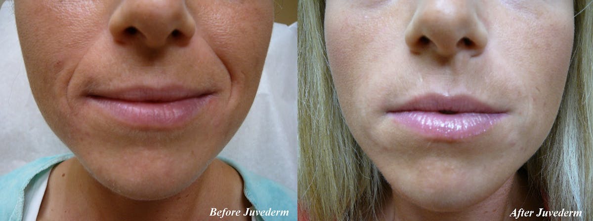 Lip Augmentation Gallery Before & After Gallery - Patient 36601654 - Image 1