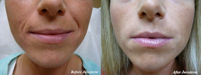 Lip Augmentation Gallery Before & After Gallery - Patient 36601654 - Image 1