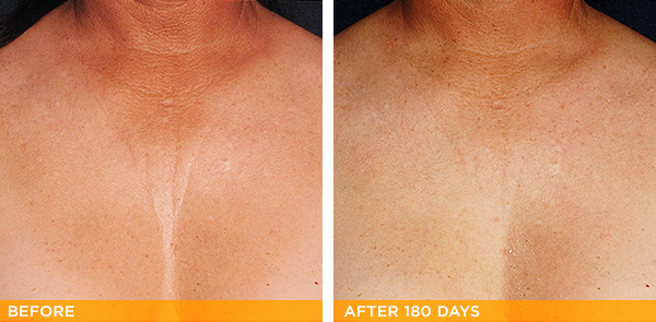 Ultherapy Before & After Gallery - Patient 36623110 - Image 1