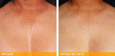 Ultherapy Gallery Before & After Gallery - Patient 36623110 - Image 1