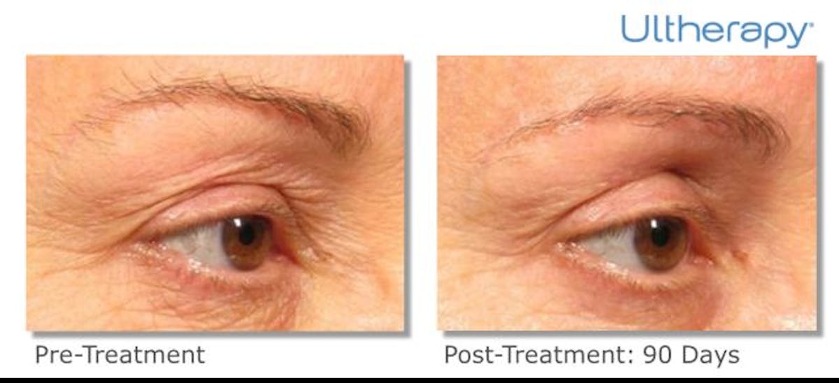 Ultherapy Gallery Before & After Gallery - Patient 36623111 - Image 1