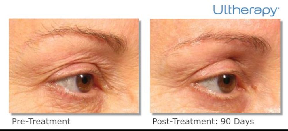 Ultherapy Before & After Gallery - Patient 36623111 - Image 1