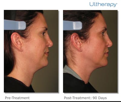 Ultherapy Gallery Before & After Gallery - Patient 36623112 - Image 1