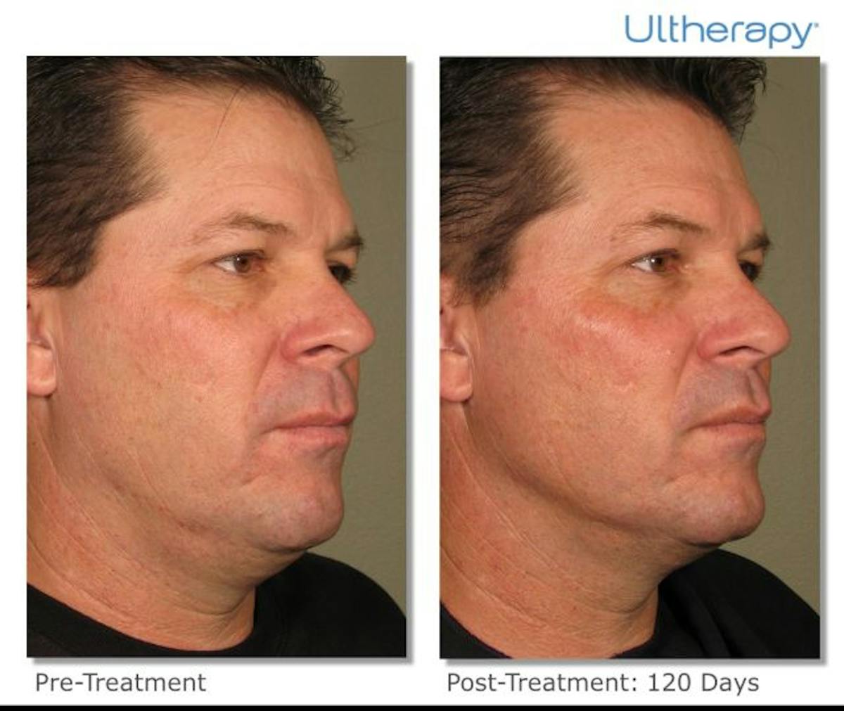 Ultherapy Gallery Before & After Gallery - Patient 36623113 - Image 1