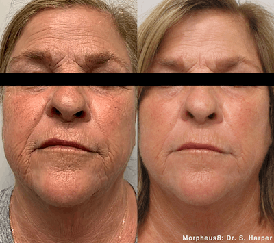 Morpheus8 Before & After Gallery - Patient 37082671 - Image 1