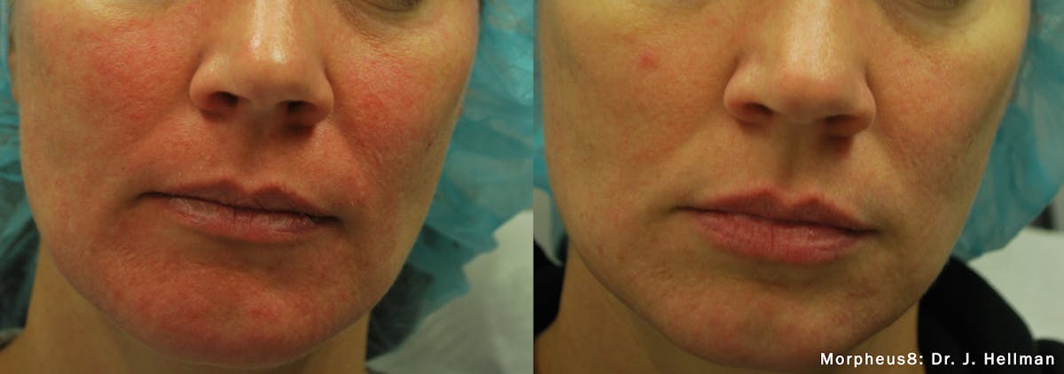 Morpheus8 Before & After Gallery - Patient 37082674 - Image 1