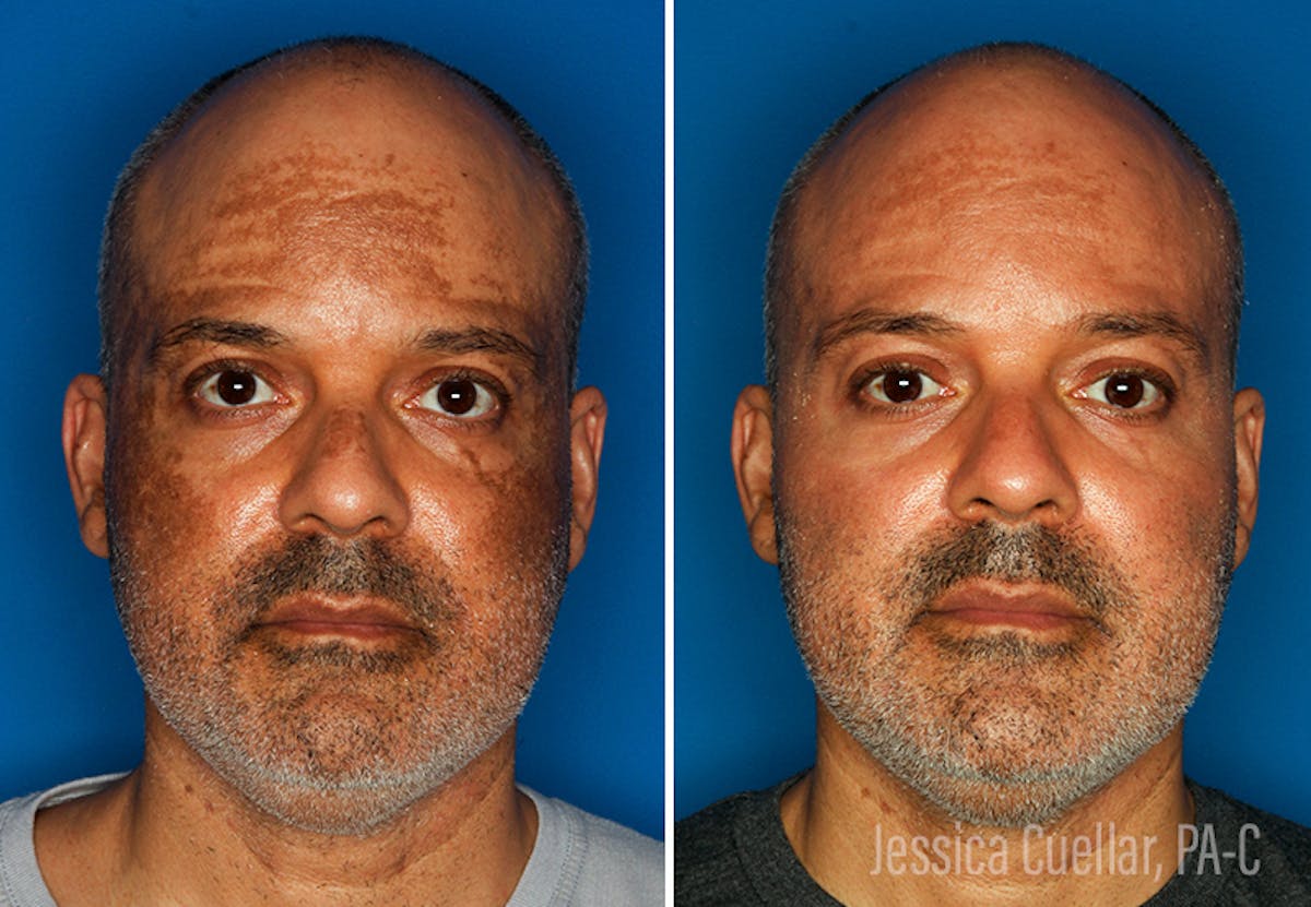 Melasma Before & After Gallery - Patient 51675005 - Image 1