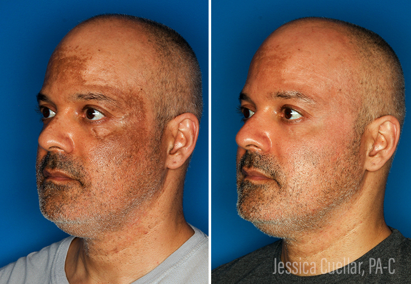Melasma Before & After Gallery - Patient 51675005 - Image 2