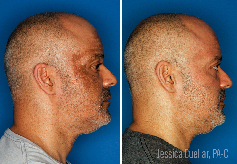 Melasma Gallery Before & After Gallery - Patient 51675005 - Image 3