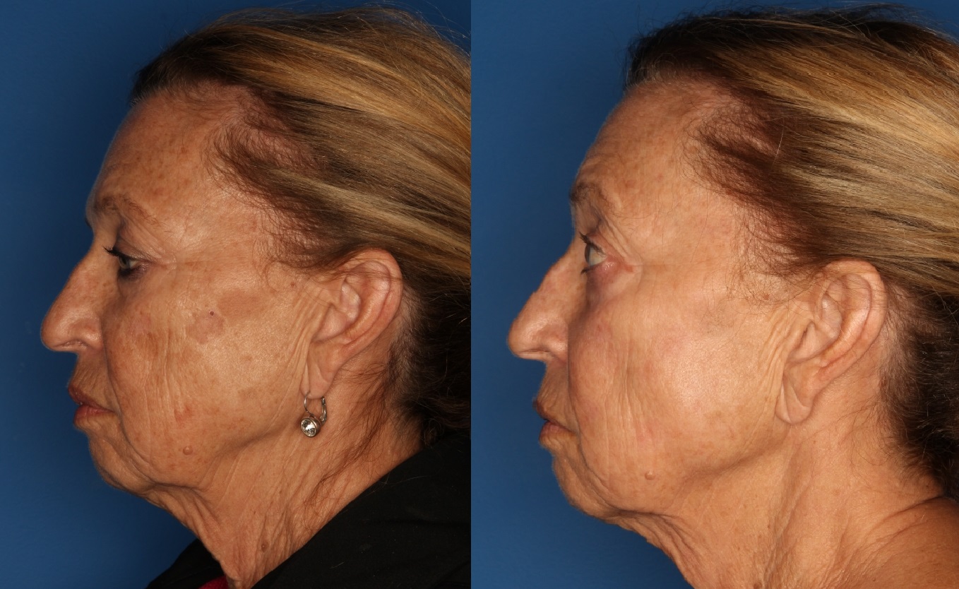 LaserFirm Before & After Gallery - Patient 41510379 - Image 1