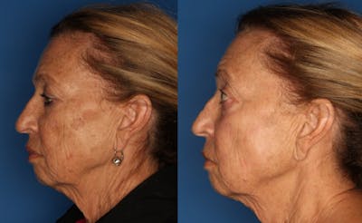 LaserFirm Gallery Before & After Gallery - Patient 41510379 - Image 1