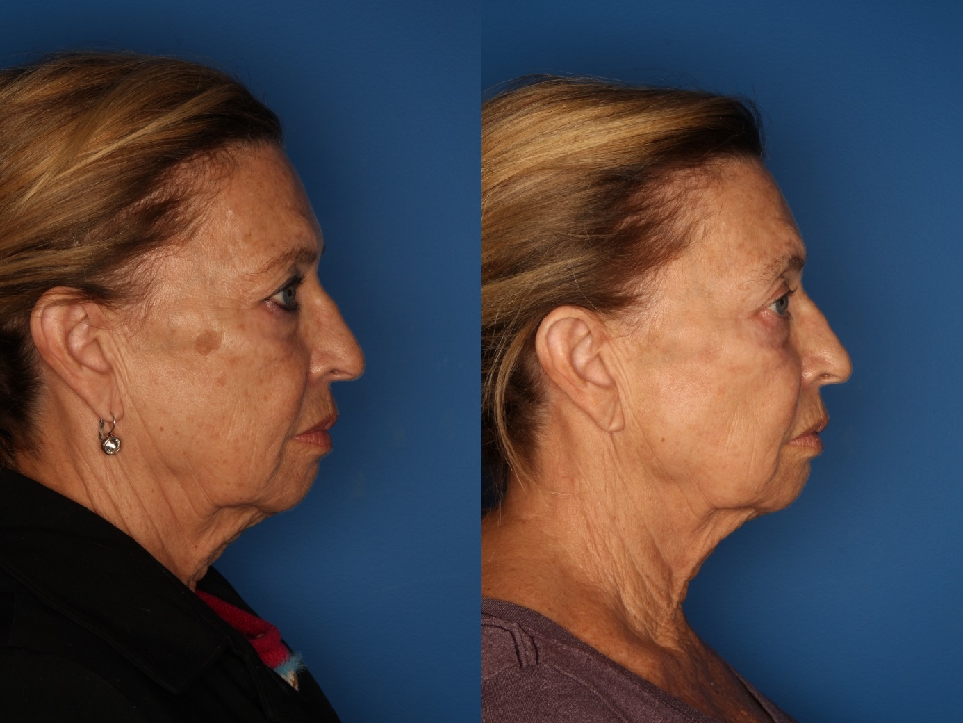 LaserFirm Gallery Before & After Gallery - Patient 41510379 - Image 2