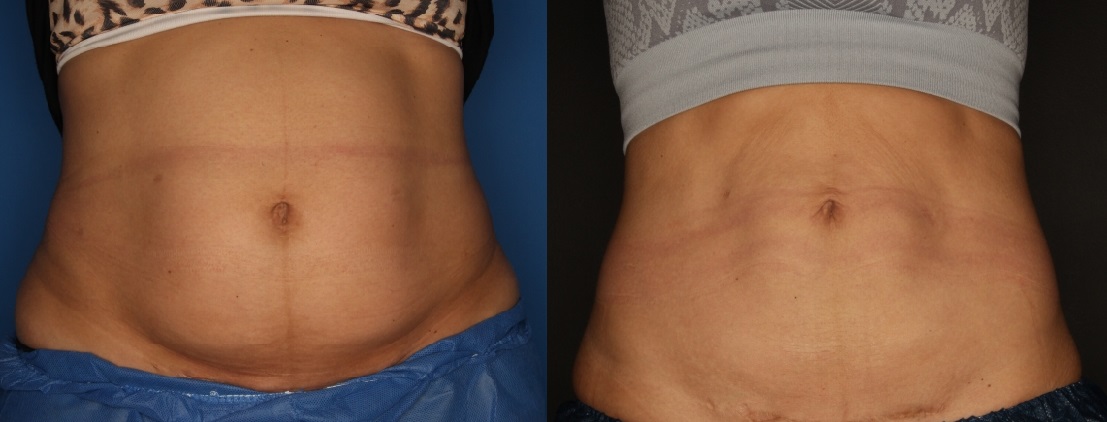 CoolSculpting Before & After Gallery - Patient 56161391 - Image 2