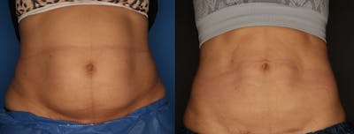 CoolSculpting Gallery Before & After Gallery - Patient 56161391 - Image 2