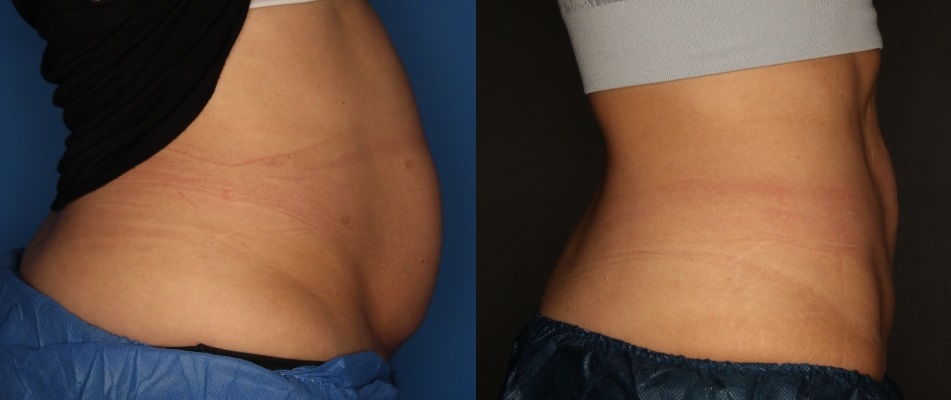 CoolSculpting Before & After Gallery - Patient 56161391 - Image 4