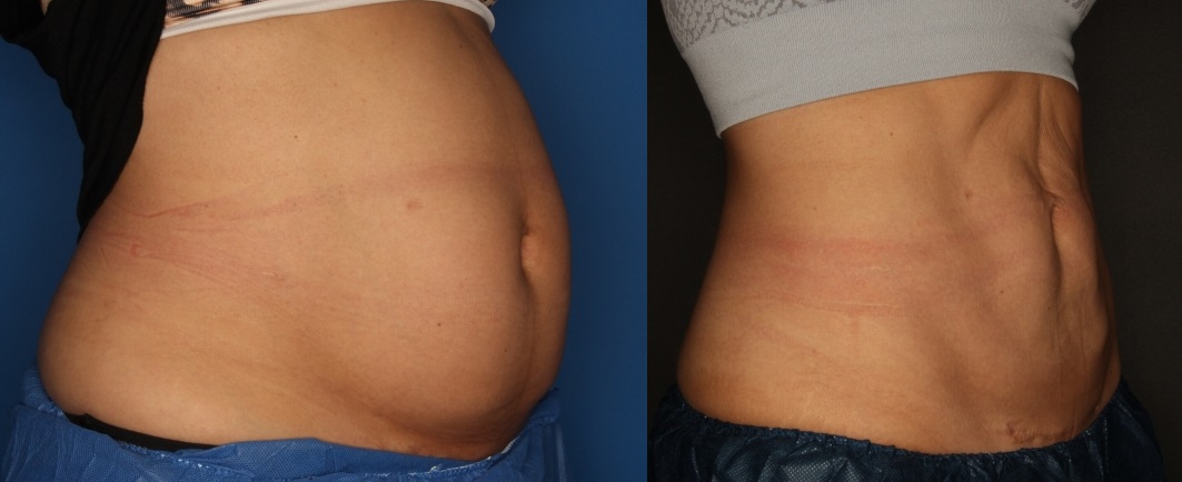 CoolSculpting Gallery Before & After Gallery - Patient 56161391 - Image 5