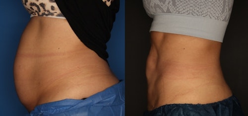 CoolSculpting Before and After 80