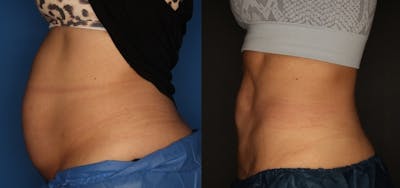CoolSculpting Before & After Gallery - Patient 56161391 - Image 1