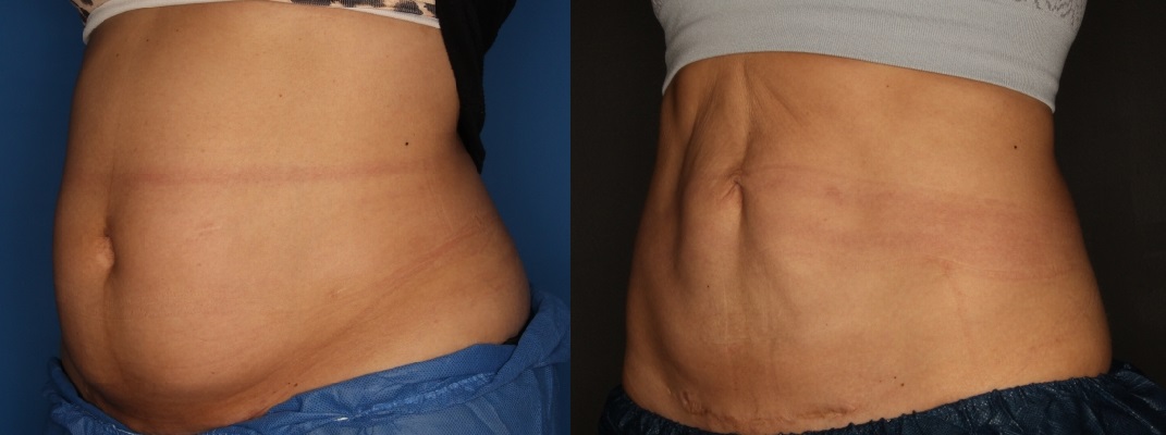 CoolSculpting Before & After Gallery - Patient 56161391 - Image 3