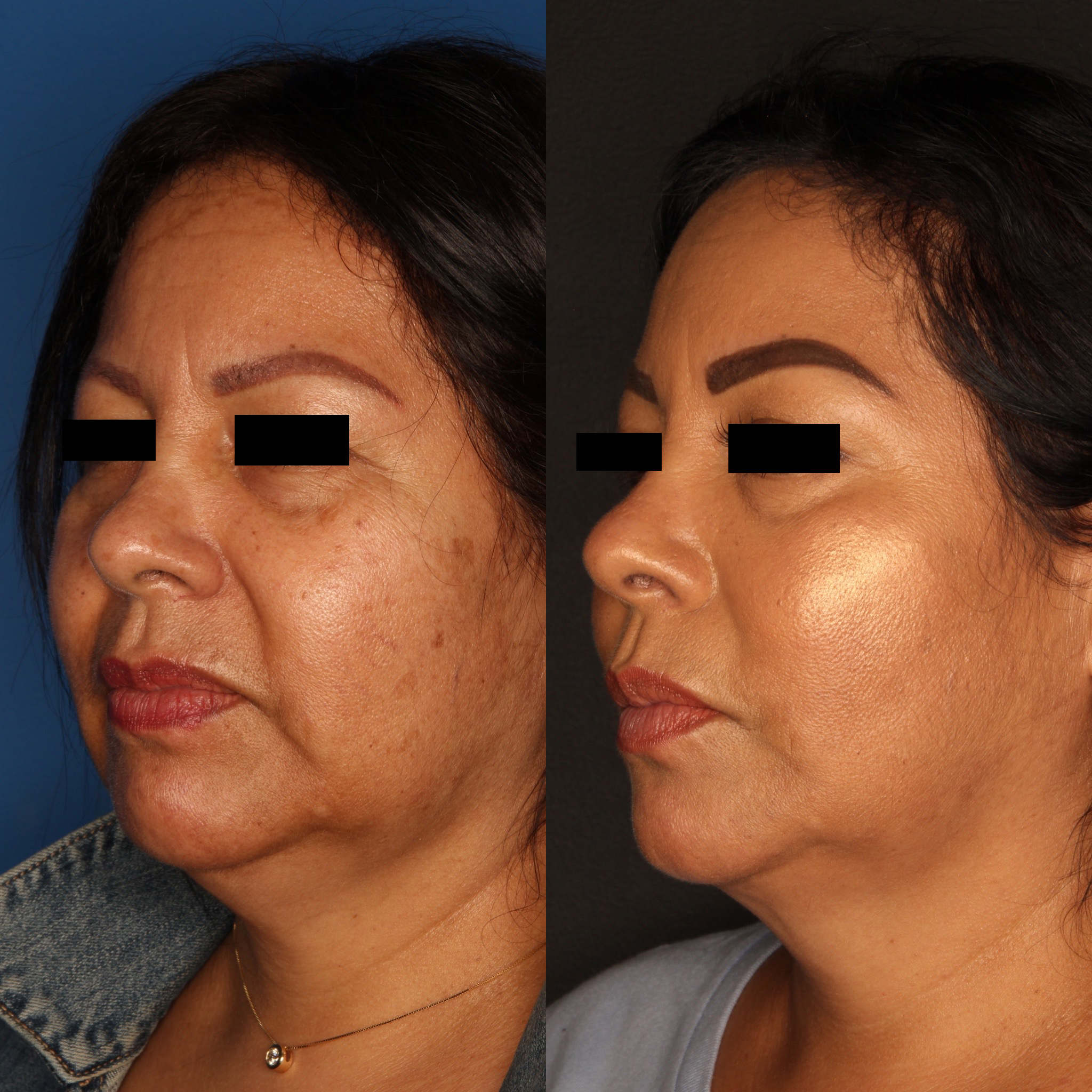 Liquid Facelift Before & After Gallery - Patient 59108135 - Image 1