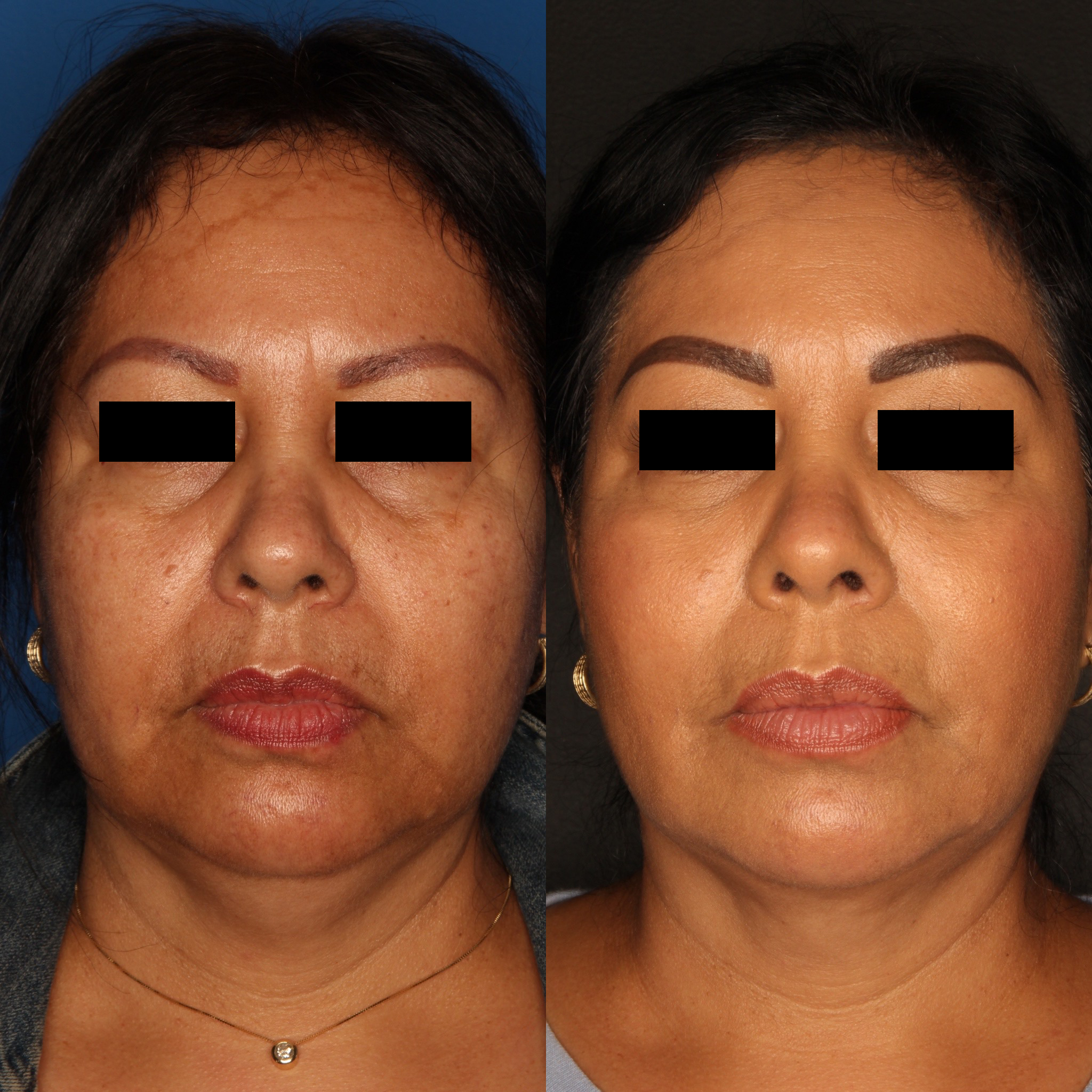 Liquid Facelift Gallery Before & After Gallery - Patient 59108135 - Image 2