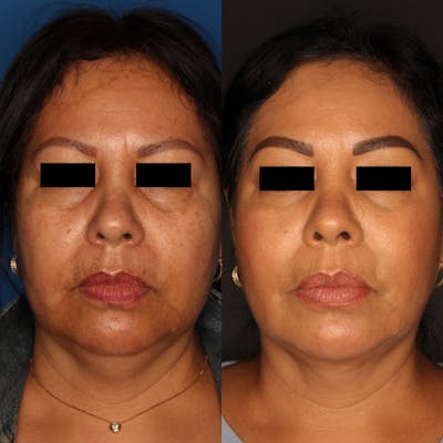 Liquid Facelift Gallery Before & After Gallery - Patient 59108135 - Image 2