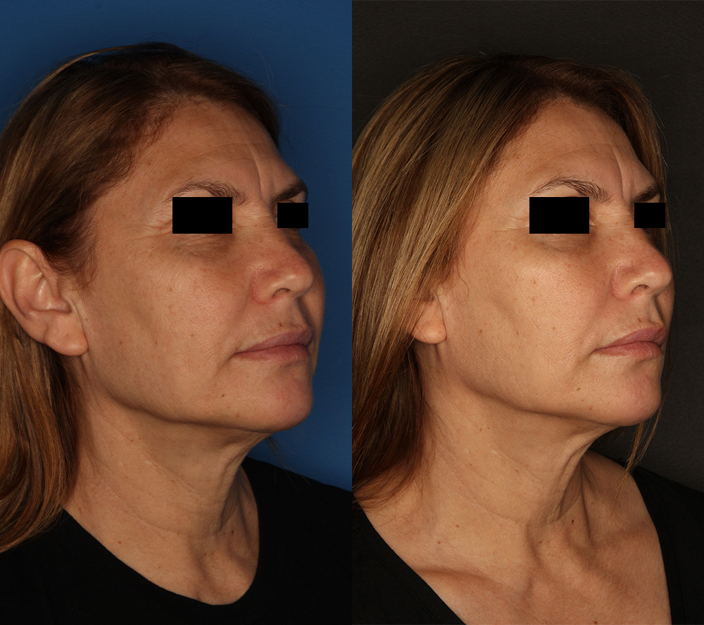 Morpheus8 Before & After Gallery - Patient 64000756 - Image 1