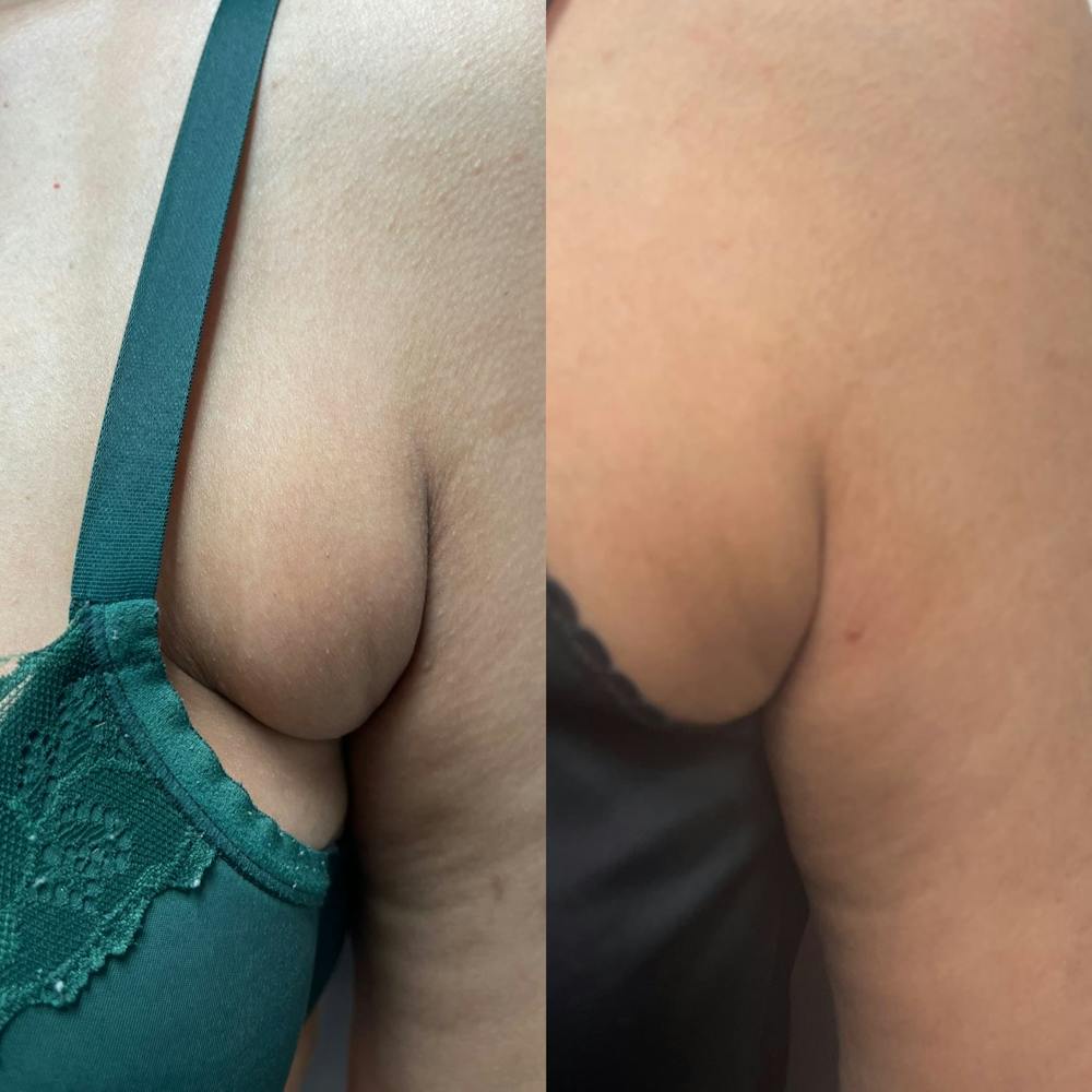 Kybella Before & After Gallery - Patient 91709032 - Image 1