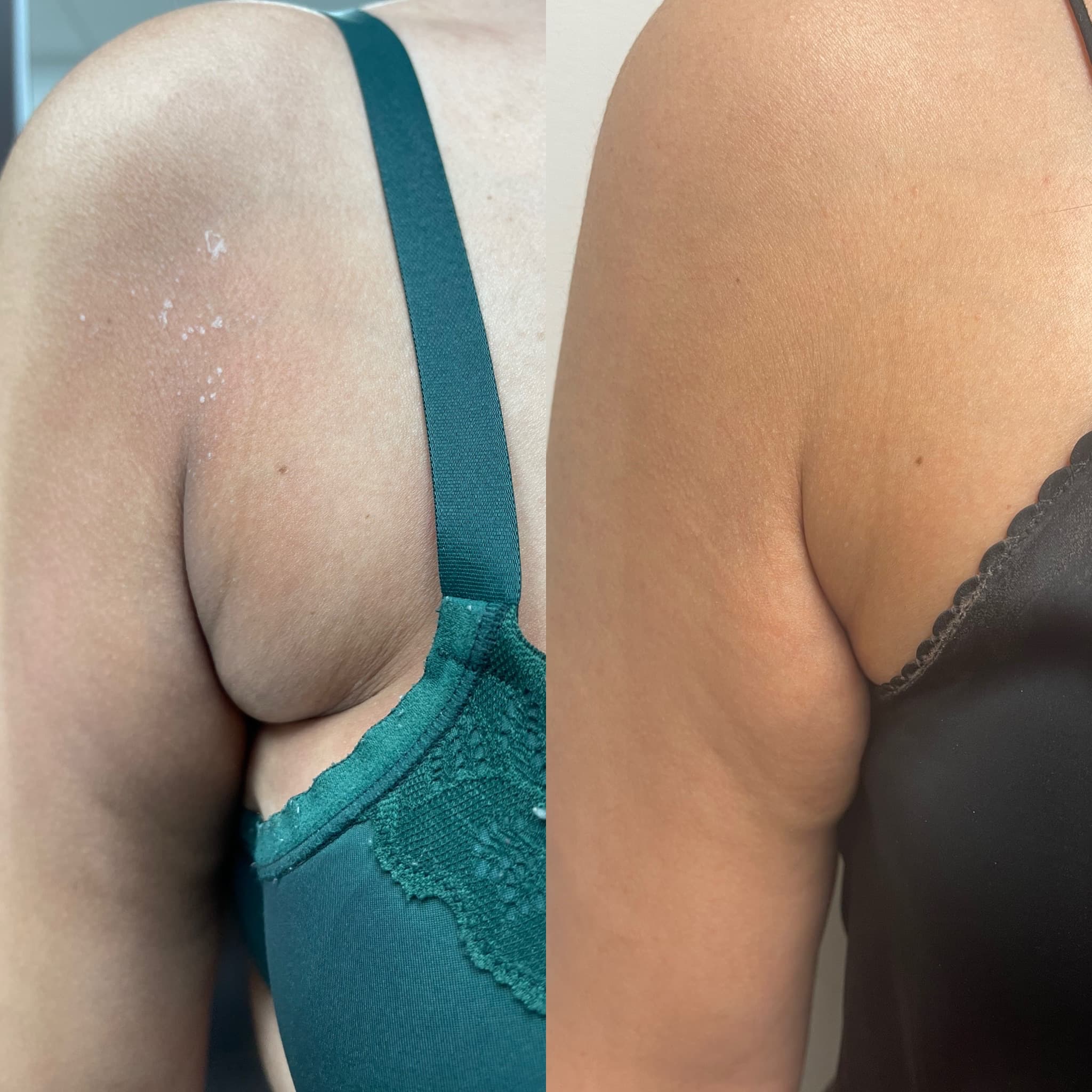 Kybella Before & After Gallery - Patient 91709032 - Image 2