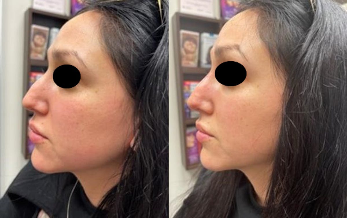 Non-Surgical Rhinoplasty Gallery Before & After Gallery - Patient 97767862 - Image 1