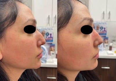 Non-Surgical Rhinoplasty Gallery Before & After Gallery - Patient 97767862 - Image 2