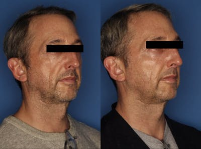 Sculptra Aesthetic Before & After Gallery - Patient 50726092 - Image 2