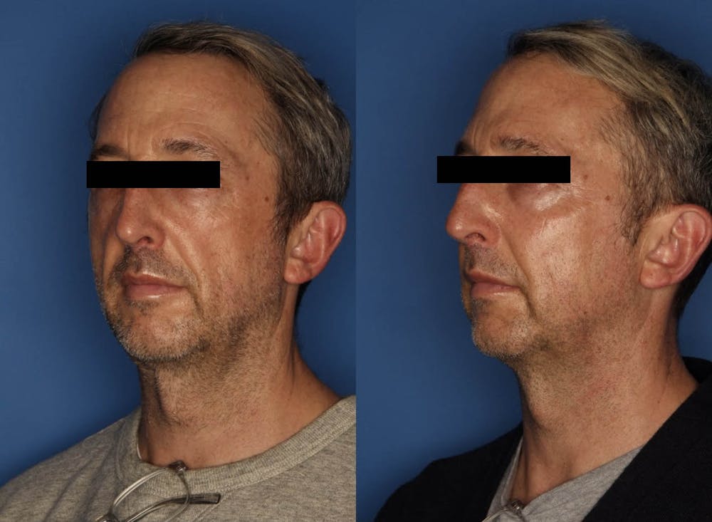 Sculptra Aesthetic Before & After Gallery - Patient 50726092 - Image 3
