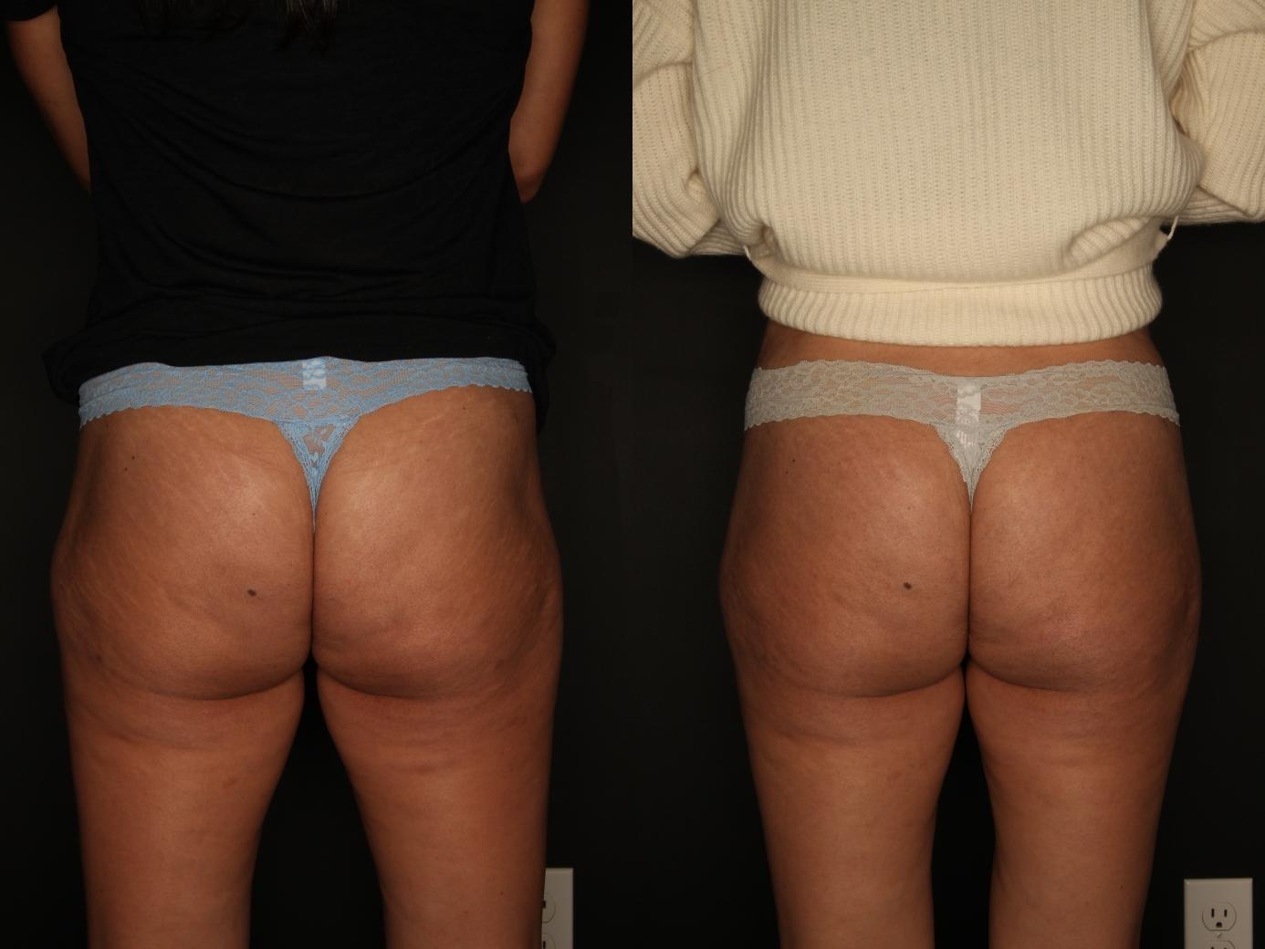 Sculptra Aesthetic Before & After Gallery - Patient 120948533 - Image 1