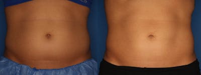 CoolSculpting Before & After Gallery - Patient 111945944 - Image 1