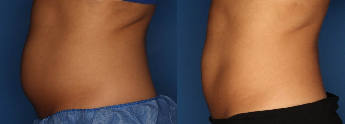 CoolSculpting Before & After Gallery - Patient 111945944 - Image 2